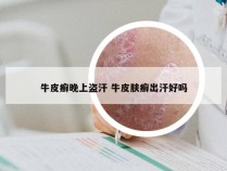 牛皮癣晚上盗汗 牛皮肤癣出汗好吗
