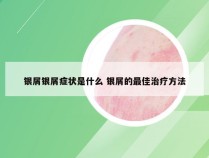 银屑银屑症状是什么 银屑的最佳治疗方法