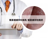 银屑病病孕妇体乳 银屑病孕妇用药