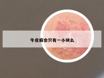 牛皮癣会只有一小块么