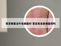 莱芜哪里治牛皮癣最好 莱芜有皮肤病医院吗