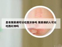 患有银屑病可以吃西洋参吗 银屑病的人可以吃西红柿吗