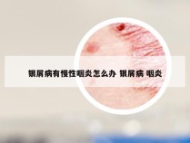 银屑病有慢性咽炎怎么办 银屑病 咽炎