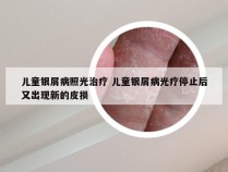 儿童银屑病照光治疗 儿童银屑病光疗停止后又出现新的皮损