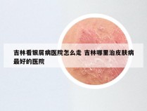 吉林看银屑病医院怎么走 吉林哪里治皮肤病最好的医院