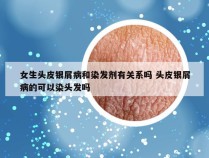 女生头皮银屑病和染发剂有关系吗 头皮银屑病的可以染头发吗