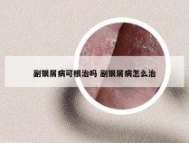 副银屑病可根治吗 副银屑病怎么治