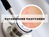 专治牛皮癣医院在哪里 专业治疗牛皮癣医院