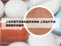 上海市看牛皮癣的医院有哪些 上海治疗牛皮病癣最好的医院