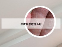 牛皮癣患吃什么好