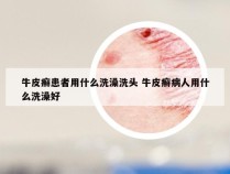 牛皮癣患者用什么洗澡洗头 牛皮癣病人用什么洗澡好
