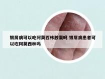 银屑病可以吃阿莫西林胶囊吗 银屑病患者可以吃阿莫西林吗