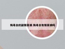 梅毒会的副银屑病 梅毒会有银屑病吗