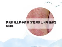 梦见脚背上长牛皮癣 梦见脚背上长牛皮癣怎么回事