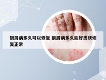 银屑病多久可以恢复 银屑病多久能好皮肤恢复正常