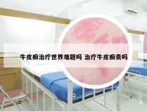 牛皮癣治疗世界难题吗 治疗牛皮癣贵吗