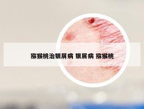 猕猴桃治银屑病 银屑病 猕猴桃
