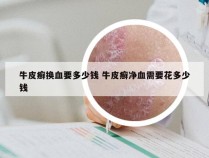 牛皮癣换血要多少钱 牛皮癣净血需要花多少钱