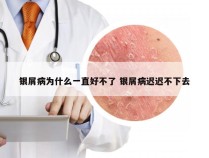 银屑病为什么一直好不了 银屑病迟迟不下去