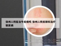 徐州二院能治牛皮癣吗 徐州二院皮肤科治疗银屑病