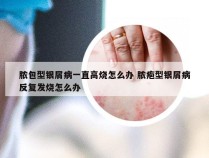 脓包型银屑病一直高烧怎么办 脓疱型银屑病反复发烧怎么办