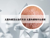 儿童头癣怎么治疗方法 儿童头癣有什么症状