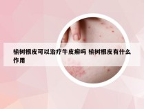 榆树根皮可以治疗牛皮癣吗 榆树根皮有什么作用