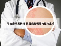 牛皮癣喝黑枸杞 银屑病能喝黑枸杞泡水吗