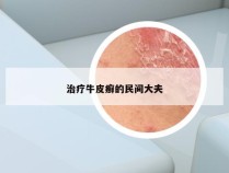 治疗牛皮癣的民间大夫