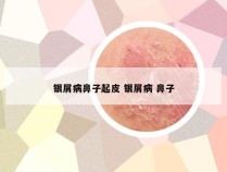 银屑病鼻子起皮 银屑病 鼻子