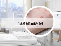 牛皮癣有没有进入血液