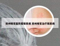 郑州哪家医院看银屑病 郑州哪家治疗银屑病