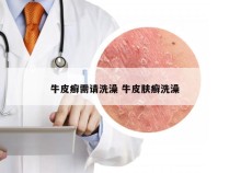 牛皮癣需请洗澡 牛皮肤癣洗澡
