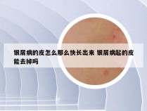 银屑病的皮怎么那么快长出来 银屑病起的皮能去掉吗