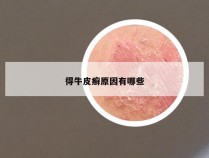 得牛皮癣原因有哪些