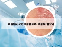 银屑病可以吃银屑颗粒吗 银屑病 适今可
