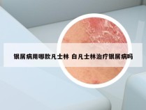 银屑病用哪款凡士林 白凡士林治疗银屑病吗