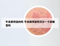 牛皮癣传染的吗 牛皮癣传染吗可以一个床睡觉吗