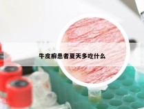 牛皮癣患者夏天多吃什么