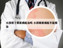 小孩得了银屑病能治吗 小孩银屑病能不能根治
