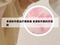 青黛粉外敷治疗银屑病 青黛粉外敷的作用 藓