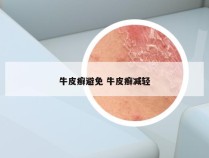牛皮癣避免 牛皮癣减轻
