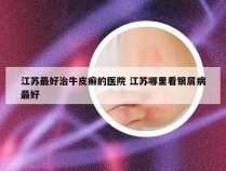 江苏最好治牛皮癣的医院 江苏哪里看银屑病最好