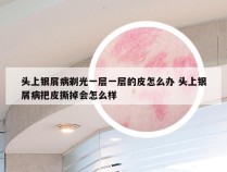 头上银屑病剃光一层一层的皮怎么办 头上银屑病把皮撕掉会怎么样