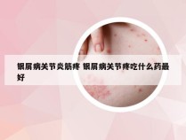 银屑病关节炎筋疼 银屑病关节疼吃什么药最好
