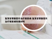 复发甘草酸苷片治疗银屑病 复发甘草酸苷片治疗银屑病效果好吗
