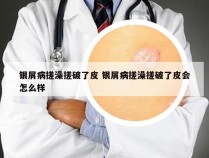 银屑病搓澡搓破了皮 银屑病搓澡搓破了皮会怎么样