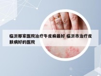 临沂那家医院冶疗牛皮癣最好 临沂市治疗皮肤病好的医院