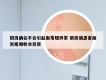 银屑病会不会引起血常规异常 银屑病患者血常规哪些会异常