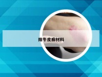 除牛皮癣材料